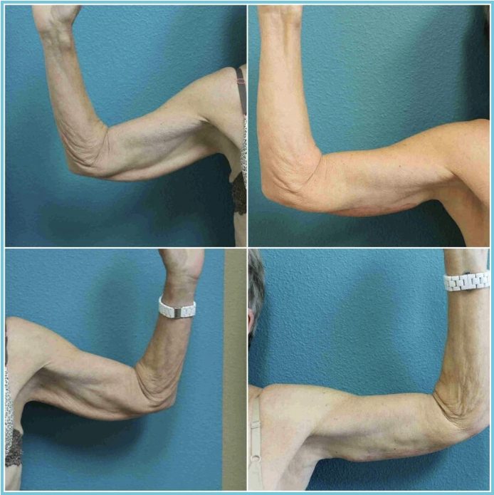 Brachioplasty (Arm Lift) before and after result