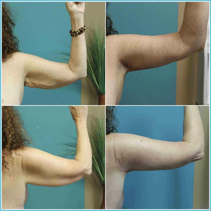Brachioplasty (Arm Lift) before and after result