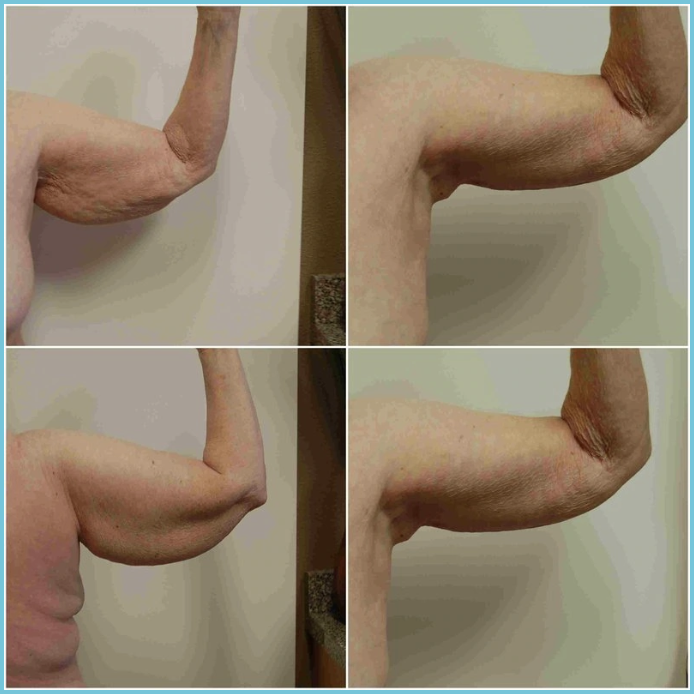 Brachioplasty (Arm Lift) before and after result