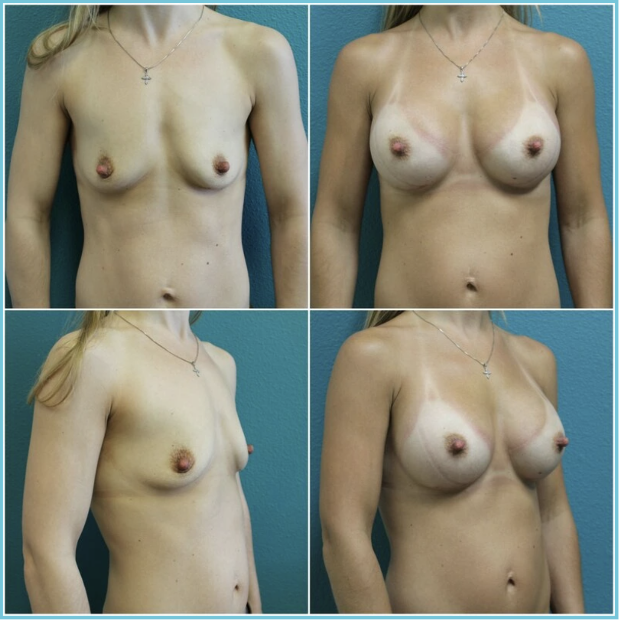 Breast Augmentation before and after result