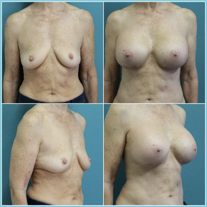 Breast Augmentation before and after result