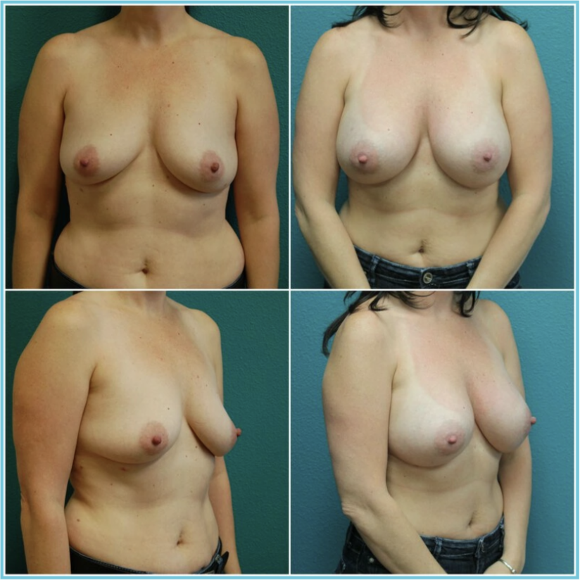 Breast Augmentation before and after result