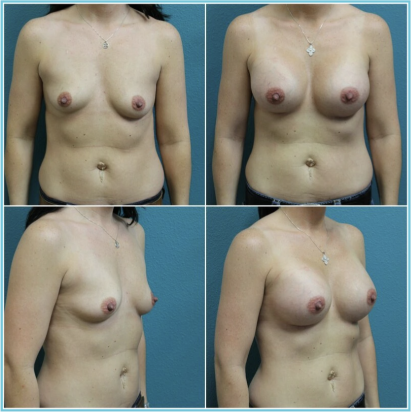 Breast Augmentation before and after result