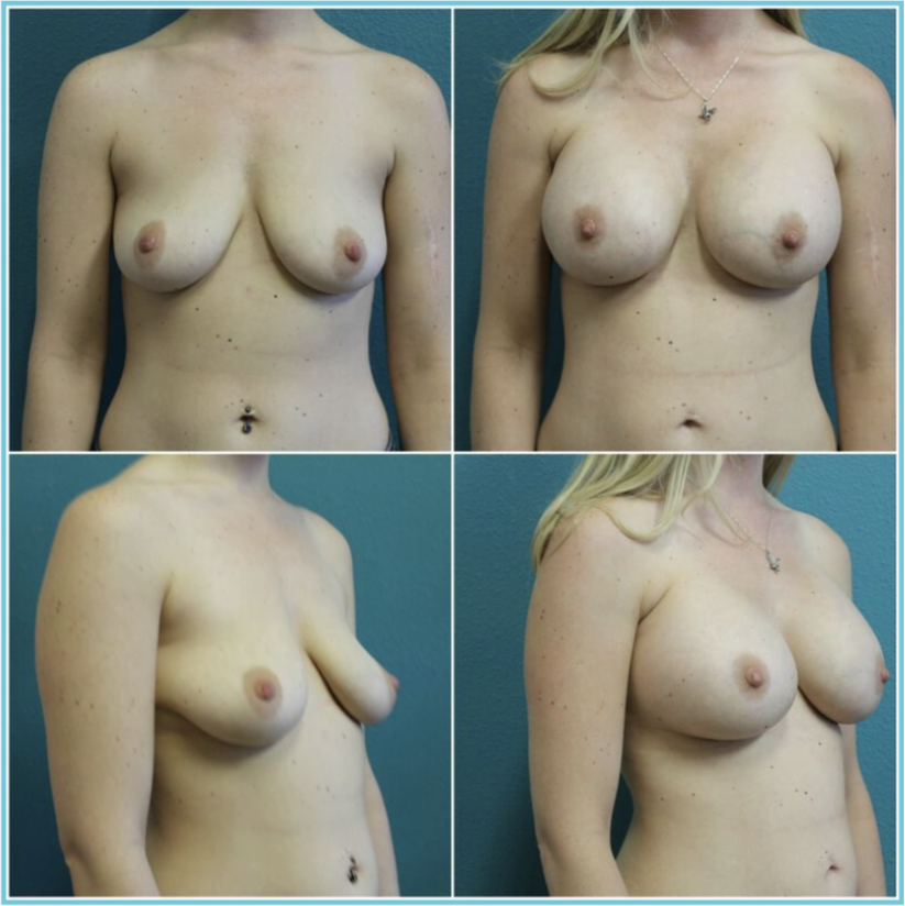 Breast Augmentation before and after result