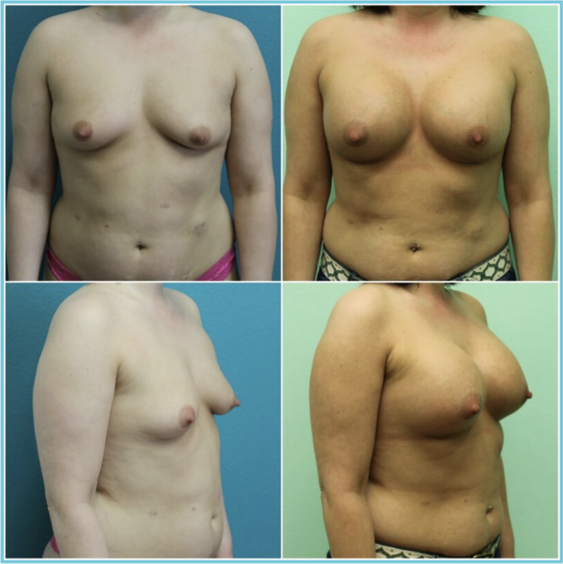 Breast Augmentation before and after result