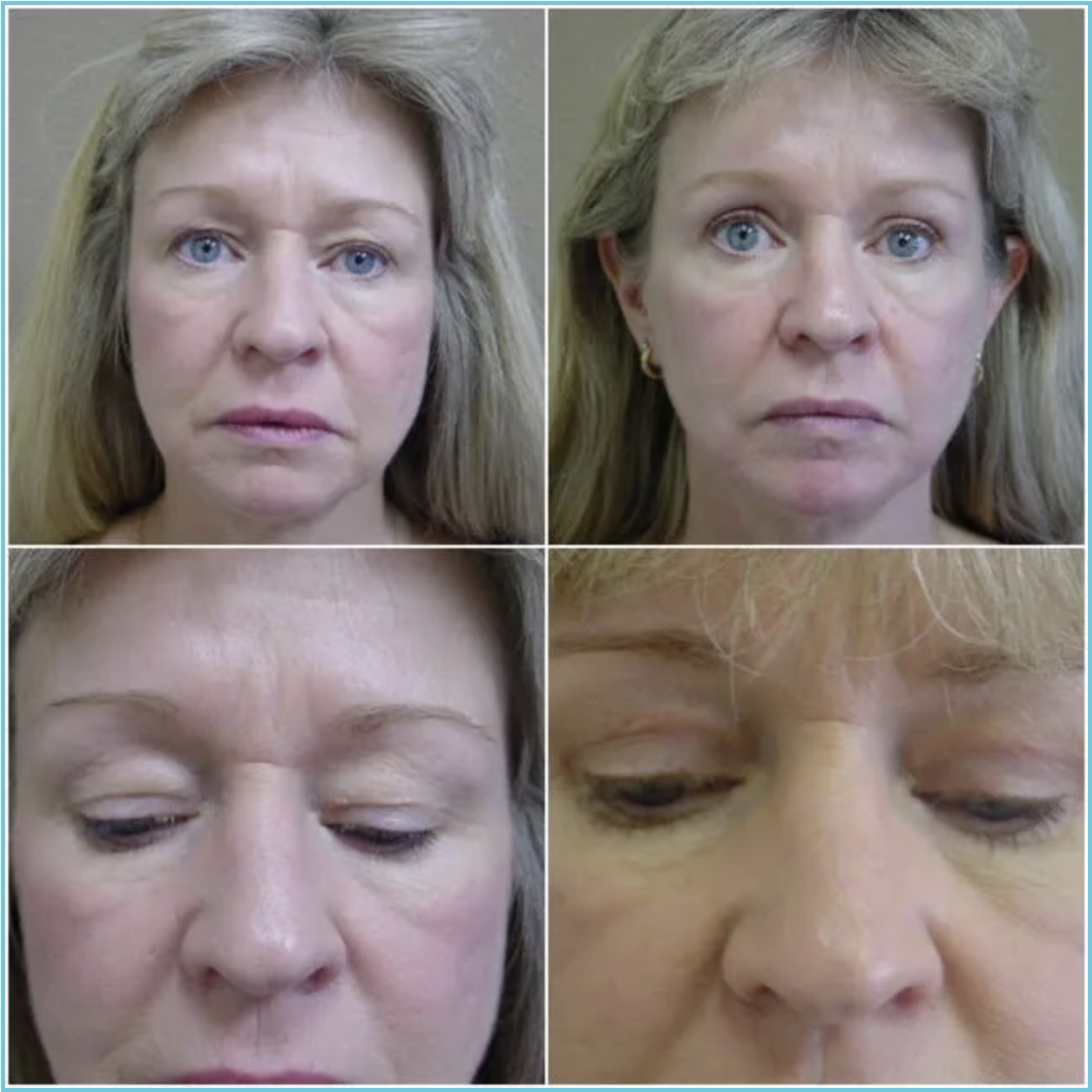 Blepharoplasty (Eyelid Lift) before and after result