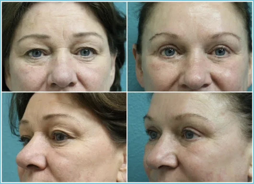 Blepharoplasty (Eyelid Lift) before and after result