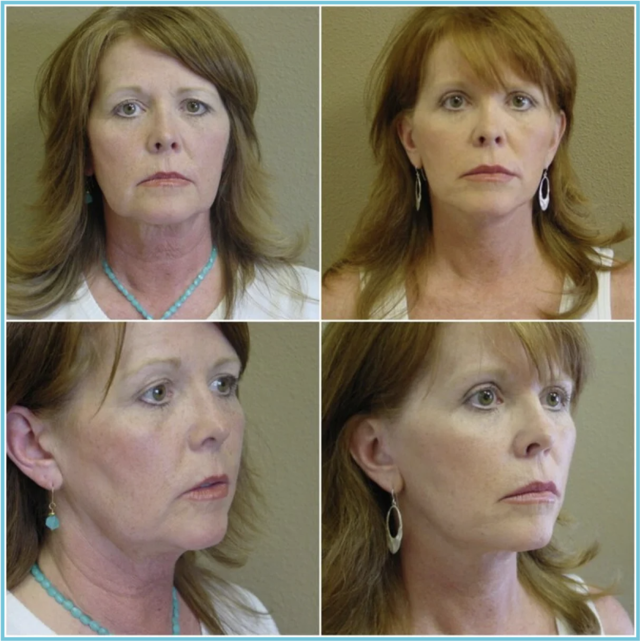 Facelift with Blepharoplasty before and after result