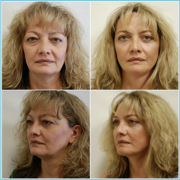 Facelift with Blepharoplasty before and after result