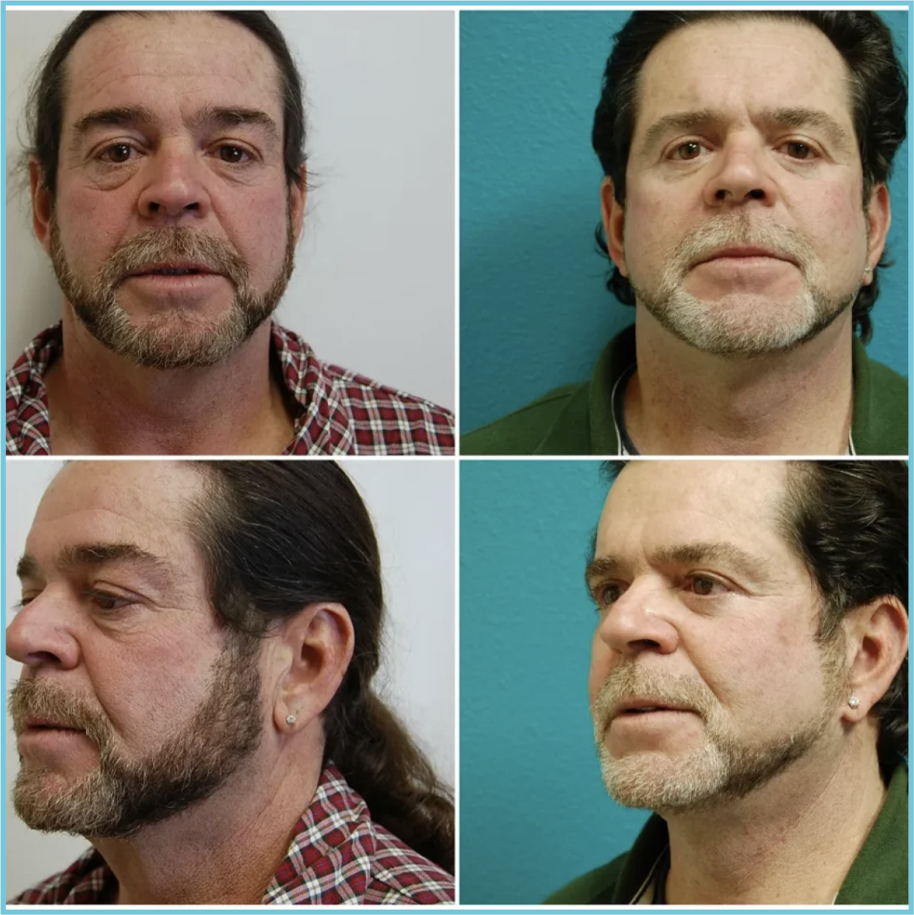 Facelift with Blepharoplasty before and after result