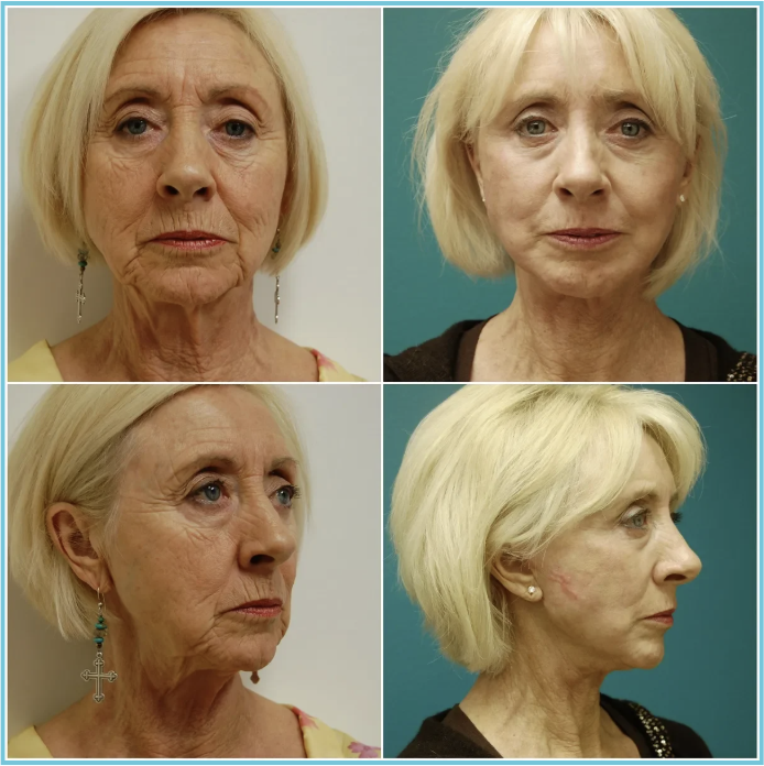 Facelift with Blepharoplasty before and after result