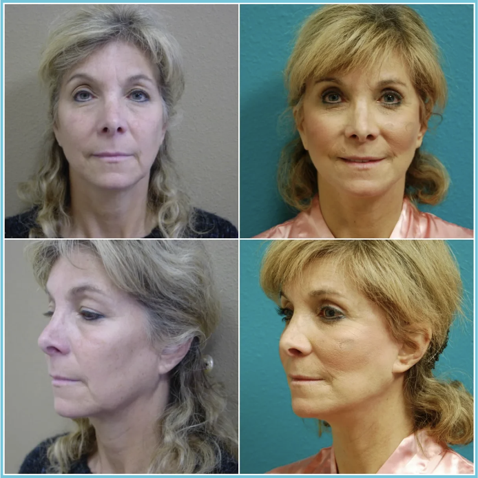Facelift with Blepharoplasty before and after result
