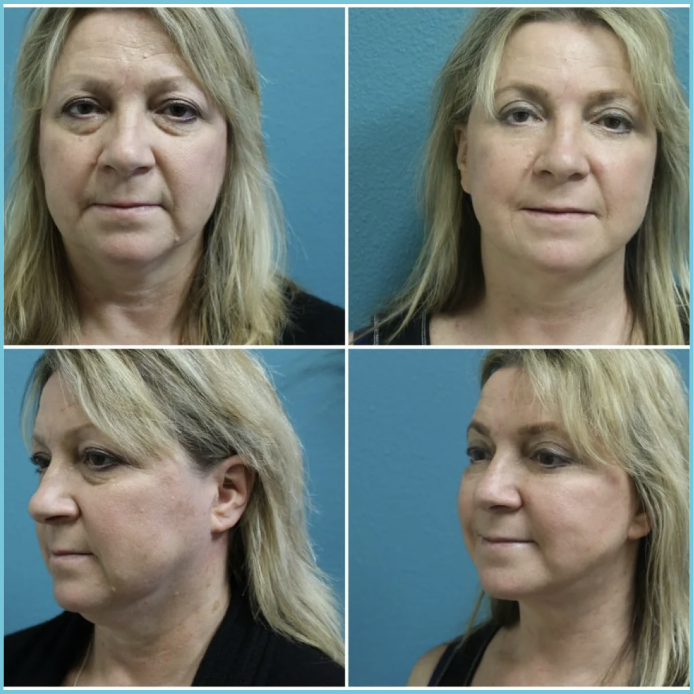 Facelift with Blepharoplasty before and after result