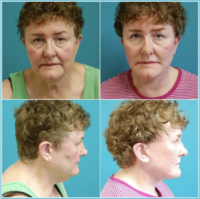 Facelift with Blepharoplasty before and after result