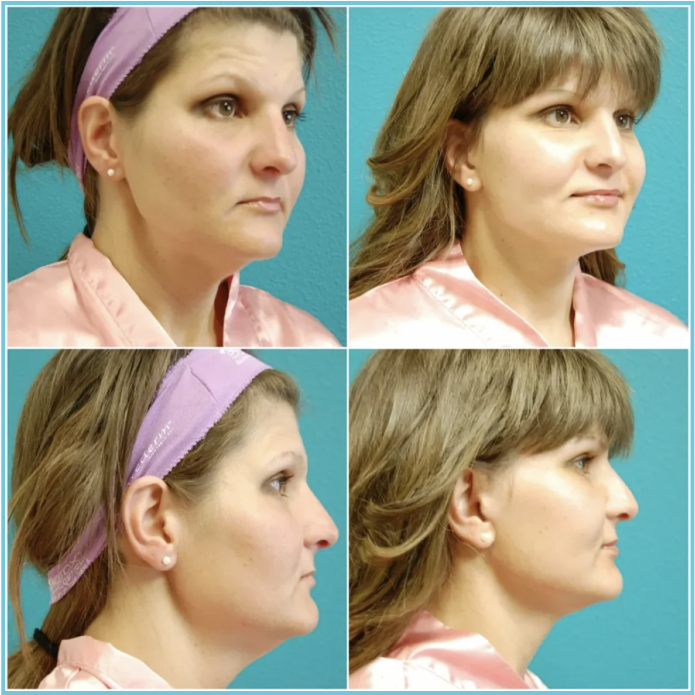 Facelift with Blepharoplasty before and after result