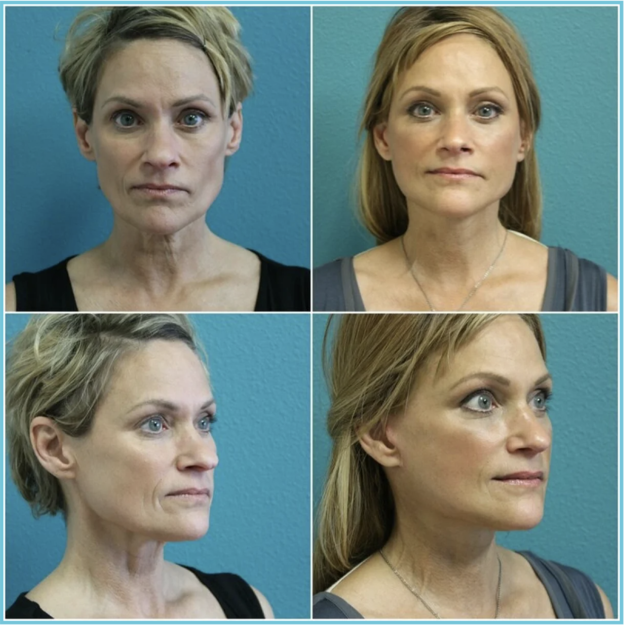 Facelift with Blepharoplasty before and after result