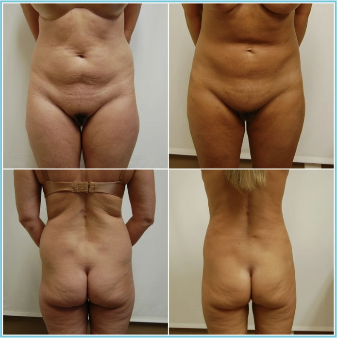 Liposuction before and after result