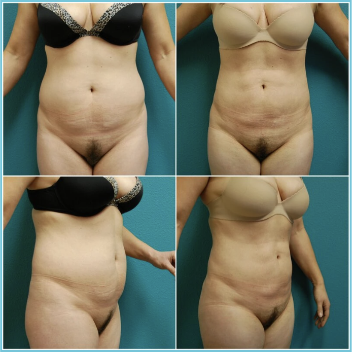 Liposuction before and after result