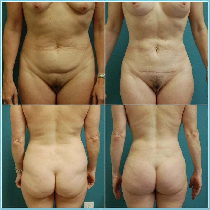 Liposuction before and after result