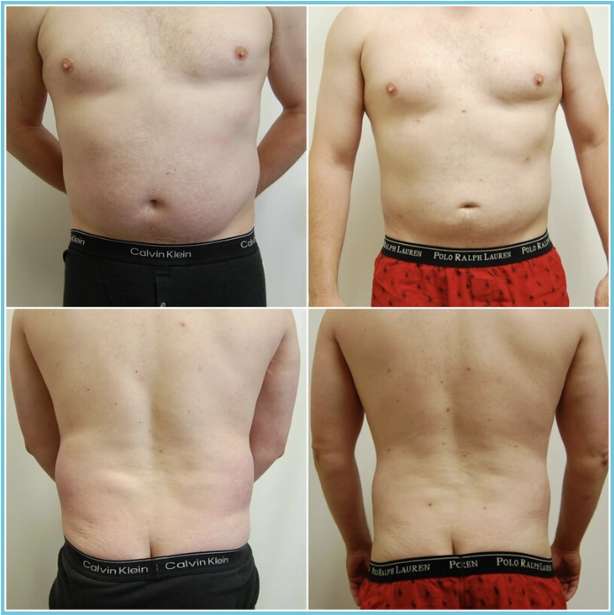 Liposuction before and after result