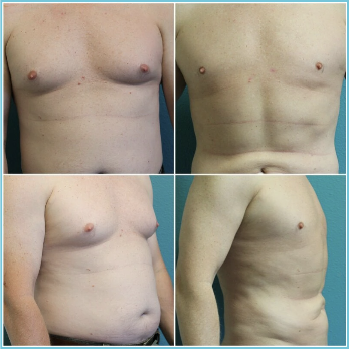 Liposuction before and after result