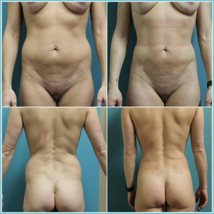 Liposuction before and after result