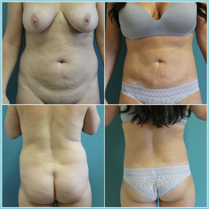 Liposuction before and after result