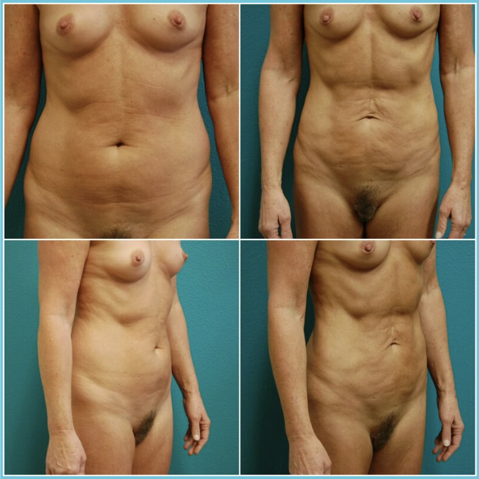 Liposuction before and after result