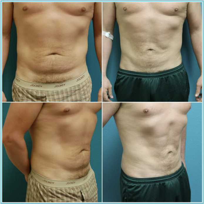 Liposuction before and after result