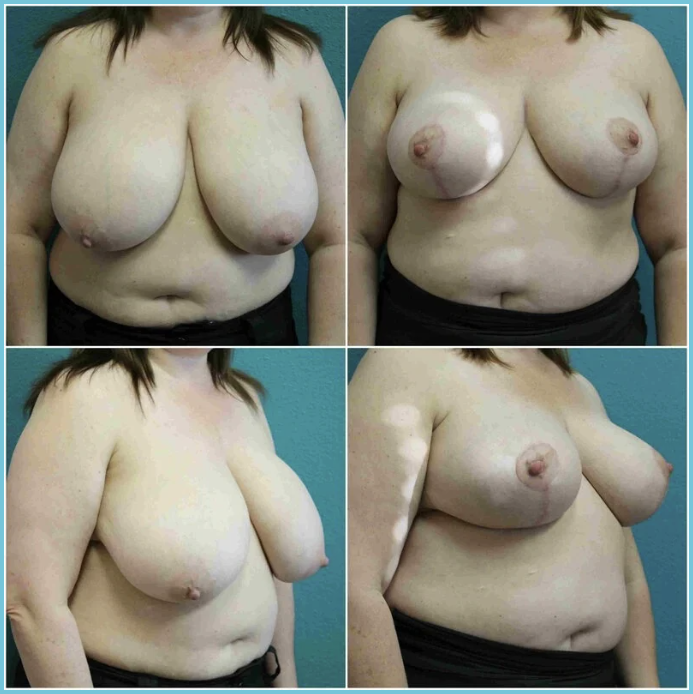 Breast Reduction before and after result