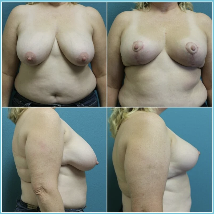 Breast Reduction before and after result