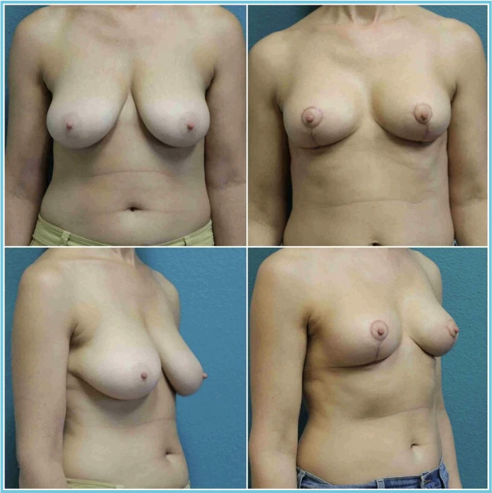 Breast Reduction before and after result