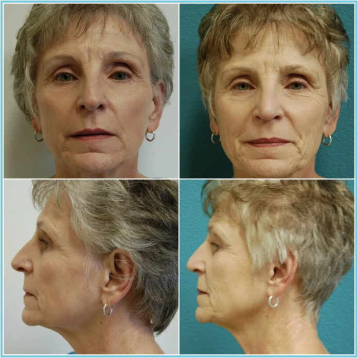 Rhinoplasty before and after result
