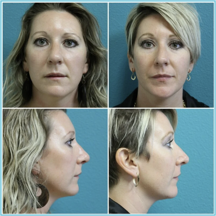 Rhinoplasty before and after result