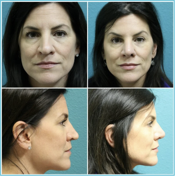 Rhinoplasty before and after result
