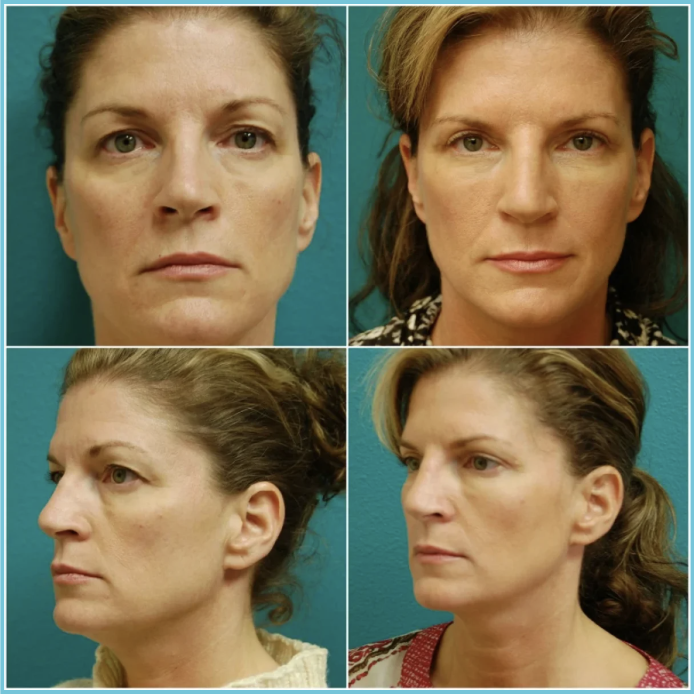 Rhinoplasty before and after result