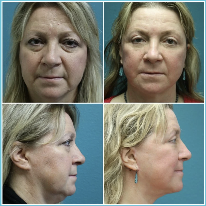 Rhinoplasty before and after result