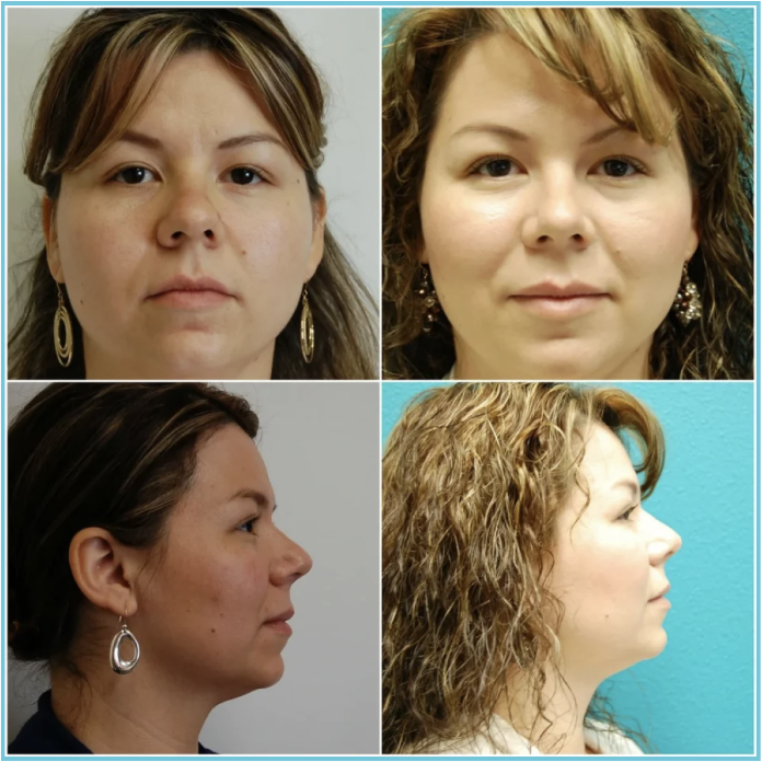 Rhinoplasty before and after result