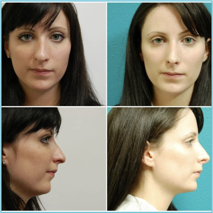 Rhinoplasty before and after result