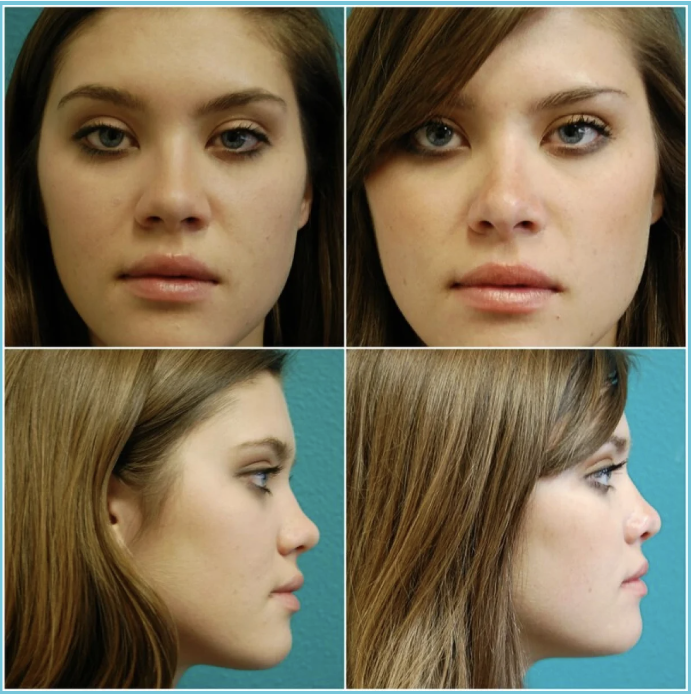 Rhinoplasty before and after result