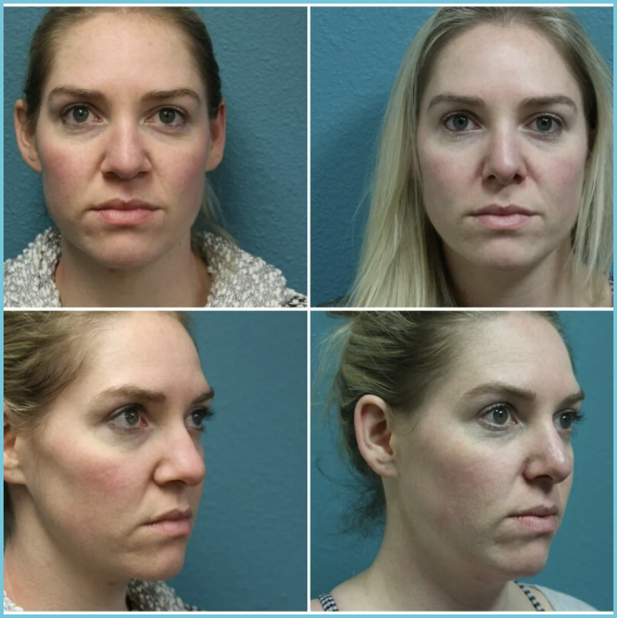 Rhinoplasty before and after result