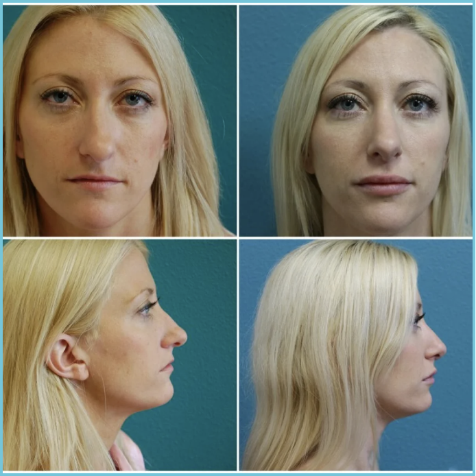 Rhinoplasty before and after result