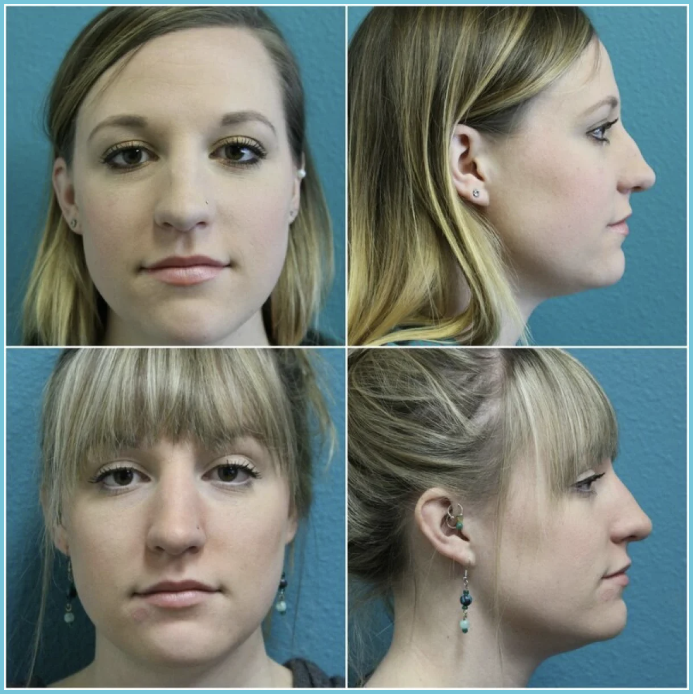 Rhinoplasty before and after result