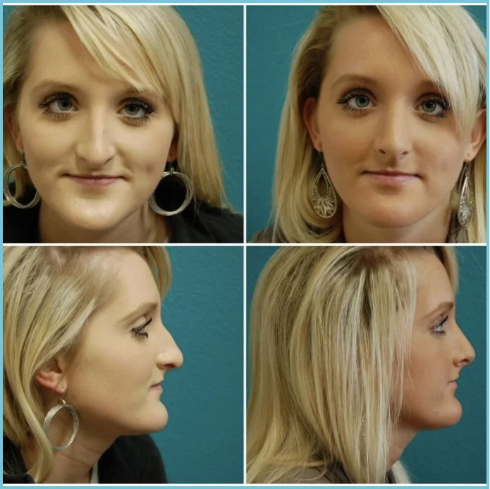 Rhinoplasty before and after result