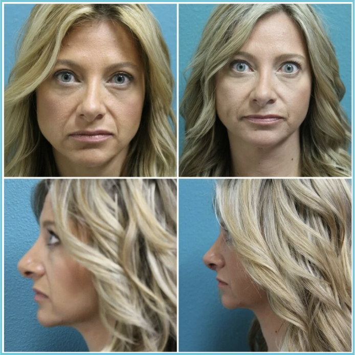 Rhinoplasty before and after result