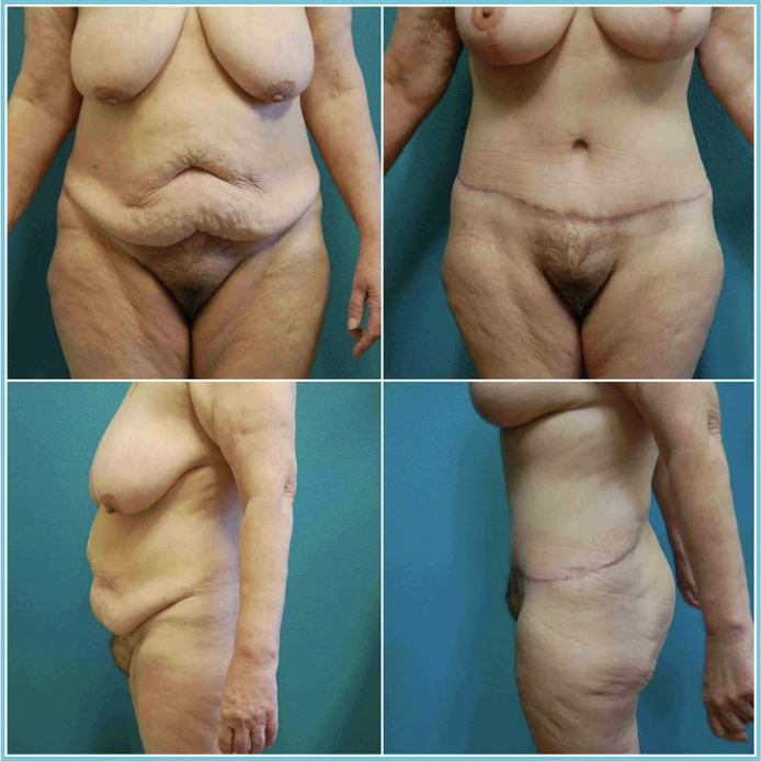 Abdominoplasty (Tummy Tuck) before and after result
