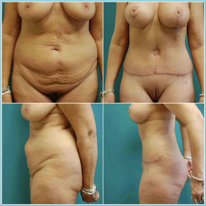 Abdominoplasty (Tummy Tuck) before and after result