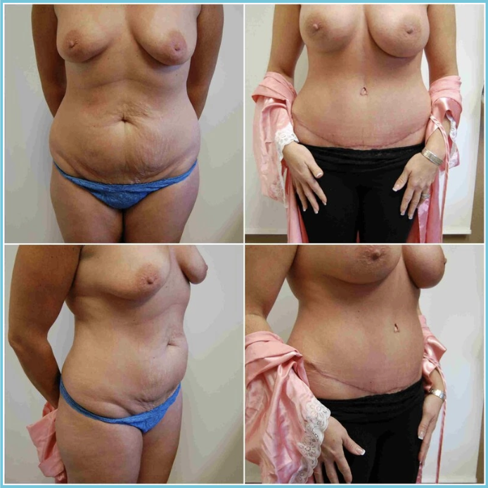 Abdominoplasty (Tummy Tuck) before and after result