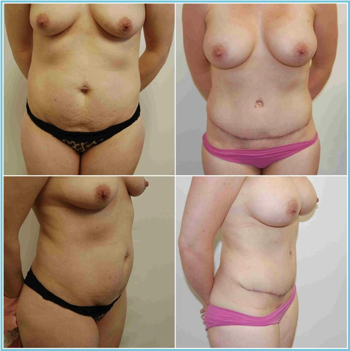 Abdominoplasty (Tummy Tuck) before and after result