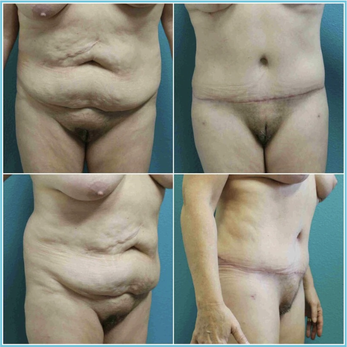 Abdominoplasty (Tummy Tuck) before and after result